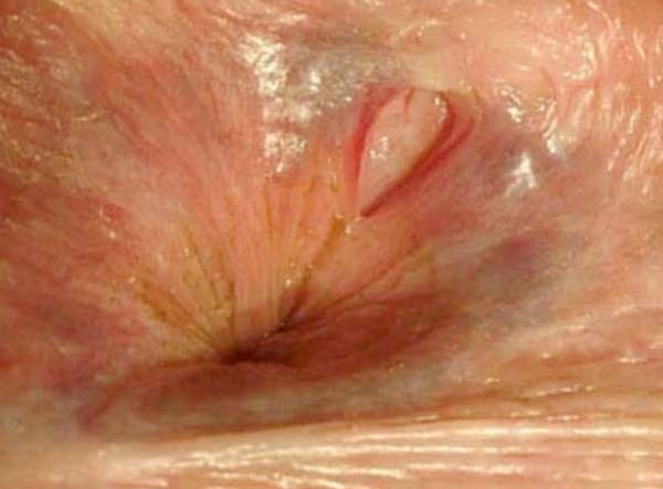 fissuur anus botox